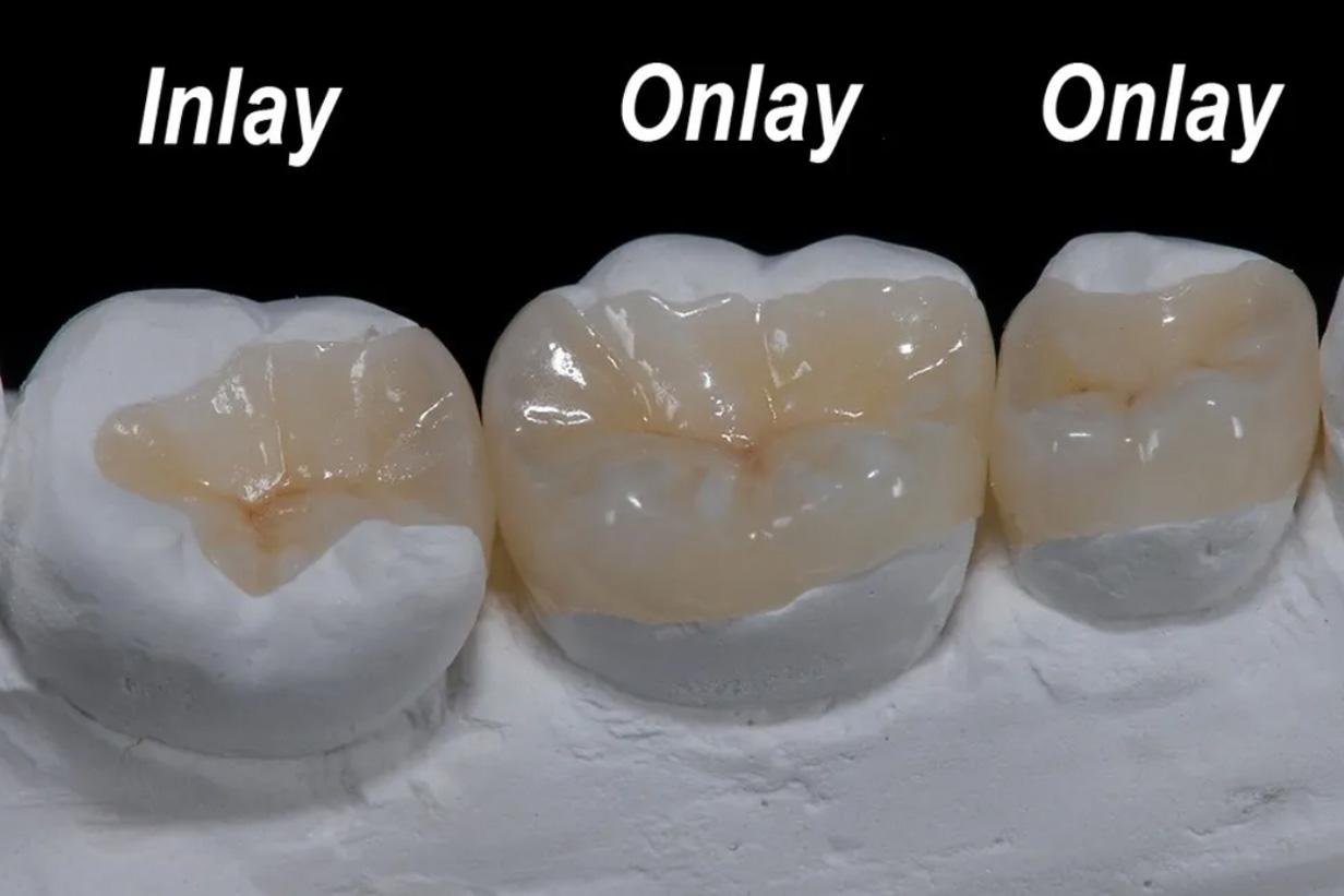 Dental inlays