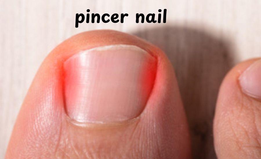 pincer nail